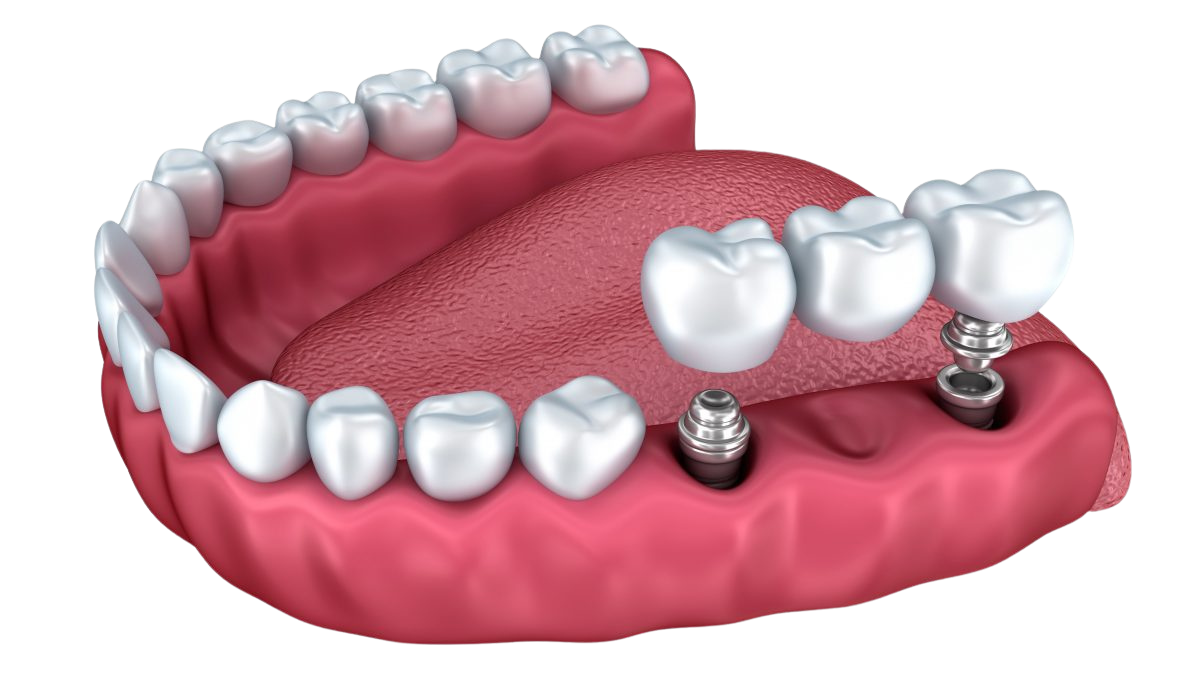 Implanturi dentare