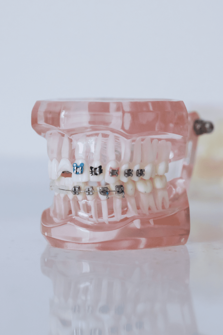 Aparat dentar: o investitie pentru sanatate