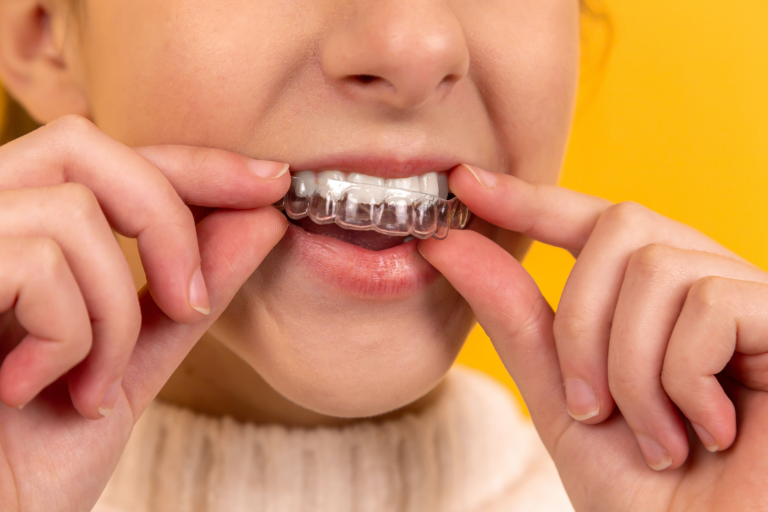 De ce sunt protecțiile dentare pentru copii esențiale?