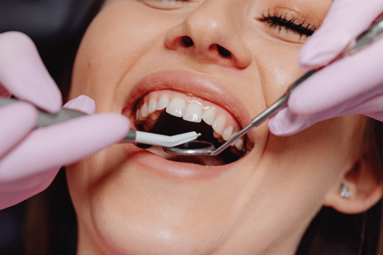 Totul despre fatete dentare