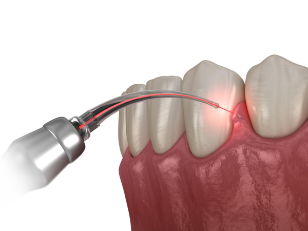 Biostimulare Laser