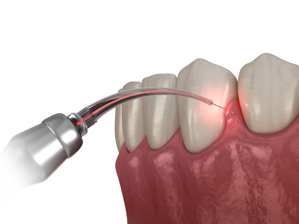 Biostimulare Laser